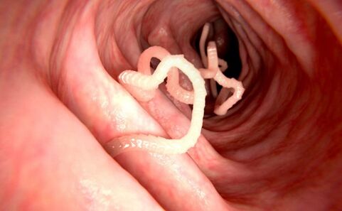 robaki w ludzkim ciele