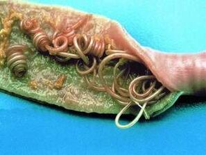 Przyczyny pasożytów w ludzkim ciele