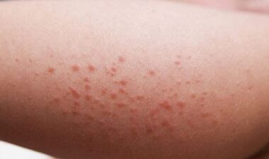 zewnętrzne objawy obecności pasożytów w organizmie